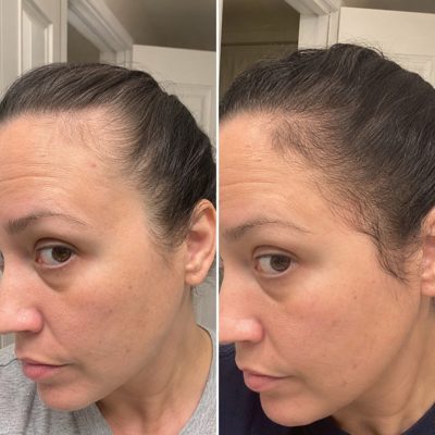 Kayla's hairline at the temples, thin at first, then with baby hairs filling in
