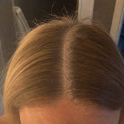 A part from above with new hairs growing in